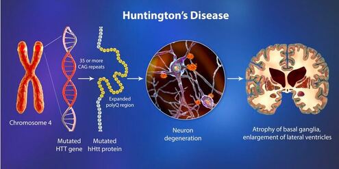 Huntington's Disease Chromosome 4 Mutated HT gene Neuron degeneration and Atrophy of Basal Ganglia