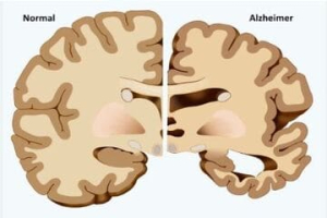 Alzheimer&#039;s Disease or Dementia - What&#039;s the Difference?