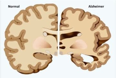 Alzheimer's Disease or Dementia - What's the Difference?